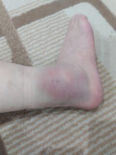 足くじいた😭